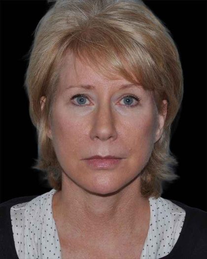 All Me Facelift Before & After Patient #263