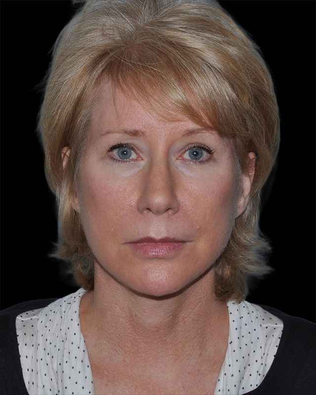 All Me Facelift Before & After Patient #263