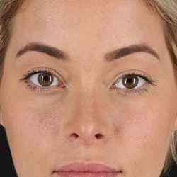 Rhinoplasty Before & After Patient #546