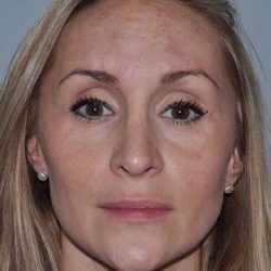 Rhinoplasty Before & After Patient #560