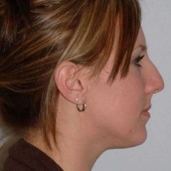 Rhinoplasty Before & After Patient #567
