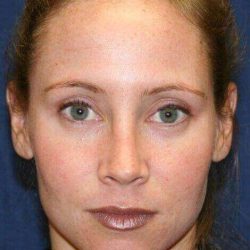Rhinoplasty Before & After Patient #588