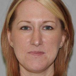 Rhinoplasty Before & After Patient #600
