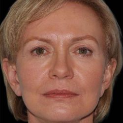All Me Facelift Before & After Patient #274
