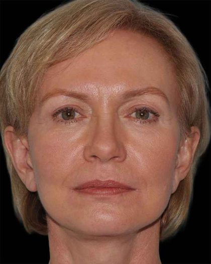 All Me Facelift Before & After Patient #274