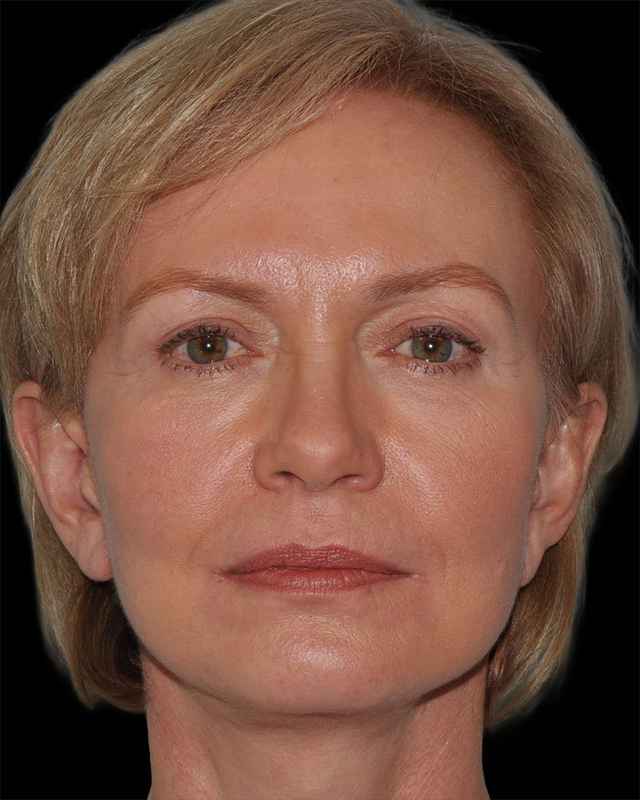 All Me Facelift Before & After Patient #274