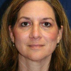 Rhinoplasty Before & After Patient #621