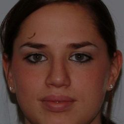 Rhinoplasty Before & After Patient #626