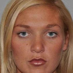Rhinoplasty Before & After Patient #633