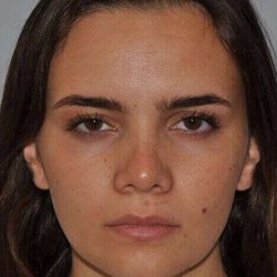 Rhinoplasty Before & After Patient #645