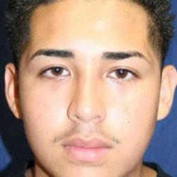 Rhinoplasty Before & After Patient #652