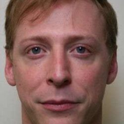 Rhinoplasty Before & After Patient #673