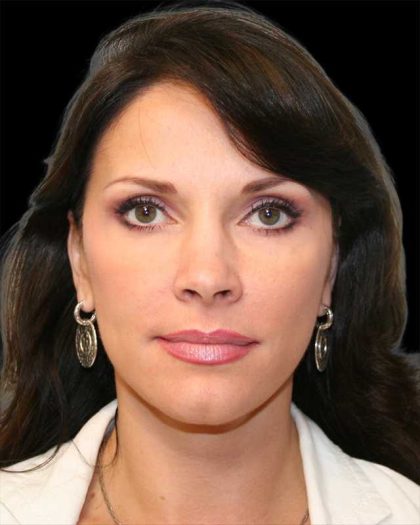 All Me Facelift Before & After Patient #286