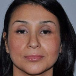 Rhinoplasty Before & After Patient #685