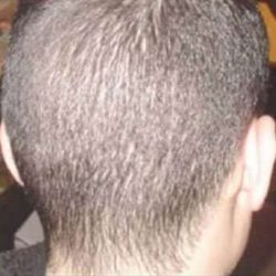 Hair Restoration Before & After Patient #711