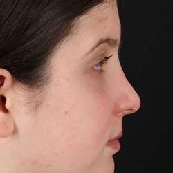 Neck Liposuction Before & After Patient #717
