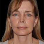 All Me Facelift Before & After Patient #297
