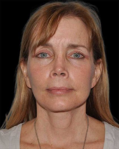 All Me Facelift Before & After Patient #297