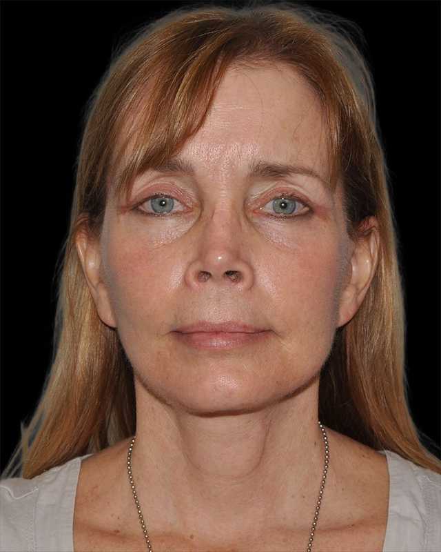 All Me Facelift Before & After Patient #297