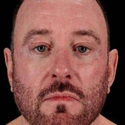 All Me Facelift Before & After Patient #728