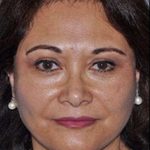 All Me Facelift Before & After Patient #749