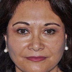 All Me Facelift Before & After Patient #749