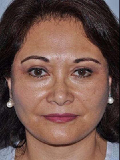 All Me Facelift Before & After Patient #749