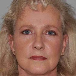All Me Facelift Before & After Patient #763