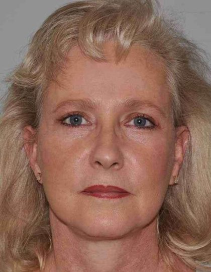 All Me Facelift Before & After Patient #763