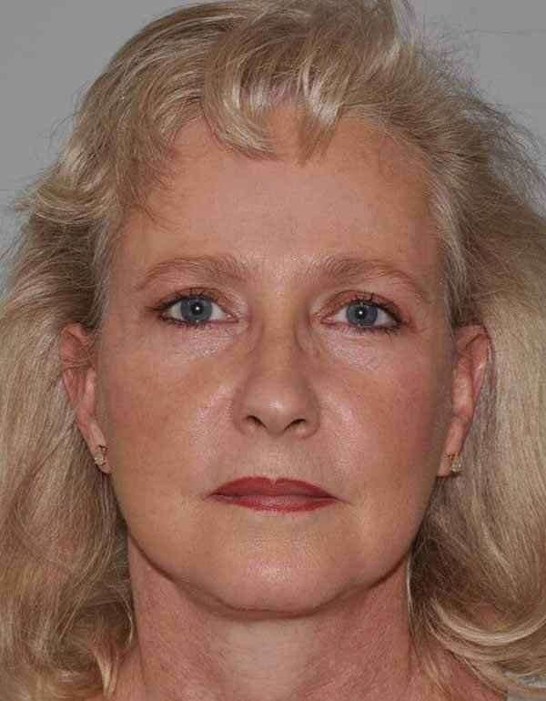All Me Facelift Before & After Patient #763