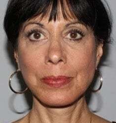All Me Facelift Before & After Patient #770