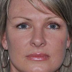 All Me Facelift Before & After Patient #781