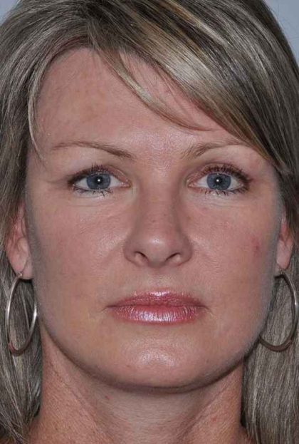 All Me Facelift Before & After Patient #781