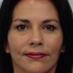All Me Facelift Before & After Patient #786