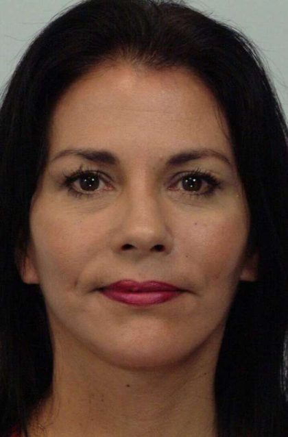 All Me Facelift Before & After Patient #786