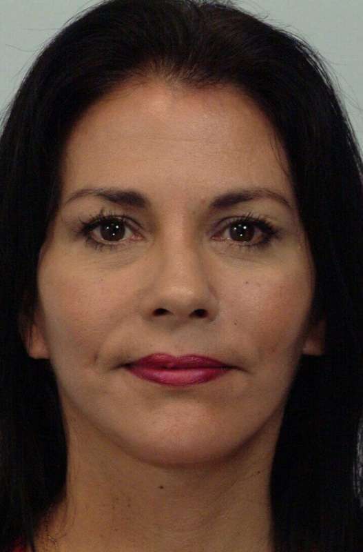 All Me Facelift Before & After Patient #786