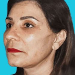 All Me Facelift Before & After Patient #789