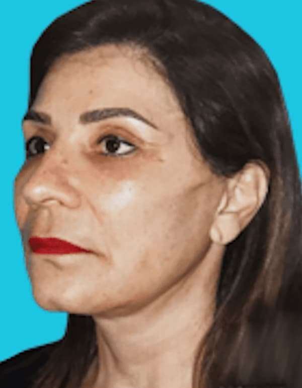 All Me Facelift Before & After Patient #789