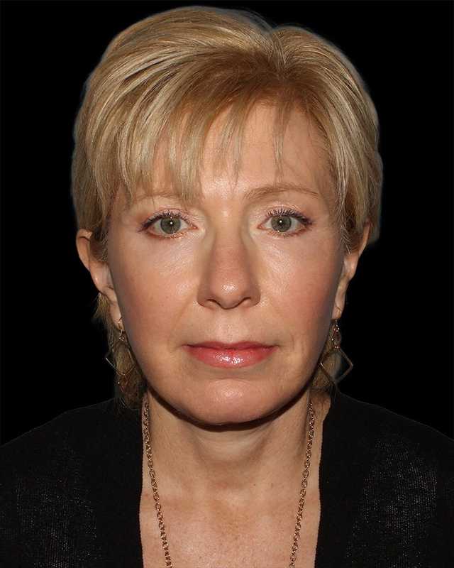 All Me Facelift Before & After Patient #308