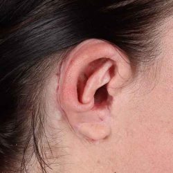 Ear Reconstruction / Microtia Before & After Patient #792