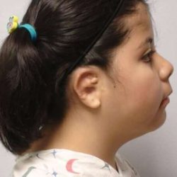 Ear Reconstruction / Microtia Before & After Patient #811