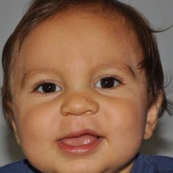 Cleft Lip Palate Before & After Patient #820