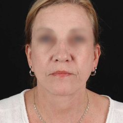 All Me Facelift Before & After Patient #320