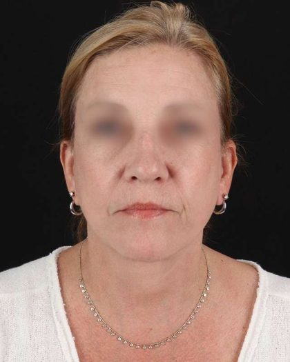 All Me Facelift Before & After Patient #320