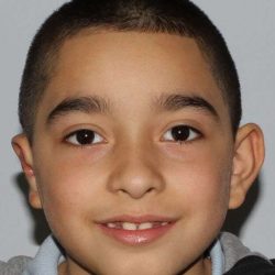 Cleft Lip Palate Before & After Patient #832