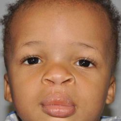 Cleft Lip Palate Before & After Patient #835
