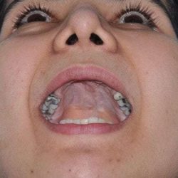 Cleft Lip Palate Before & After Patient #844
