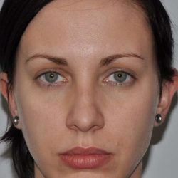 Chin Surgery Before & After Patient #854