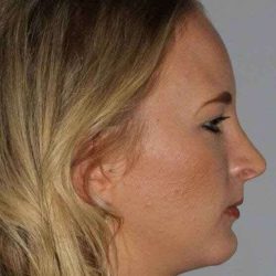 Chin Surgery Before & After Patient #857