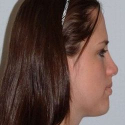 Chin Surgery Before & After Patient #865